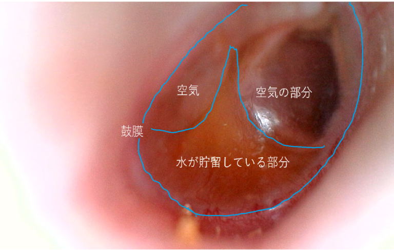 小児 滲出性中耳炎 | どい耳鼻咽喉科 船橋日大駅前院